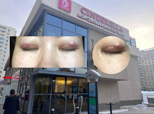 Синдерелла мэс заслын эмнэлэг: Манайд нүдний сүв гэмтээсэн талаар ямар ч гомдол ирээгүй